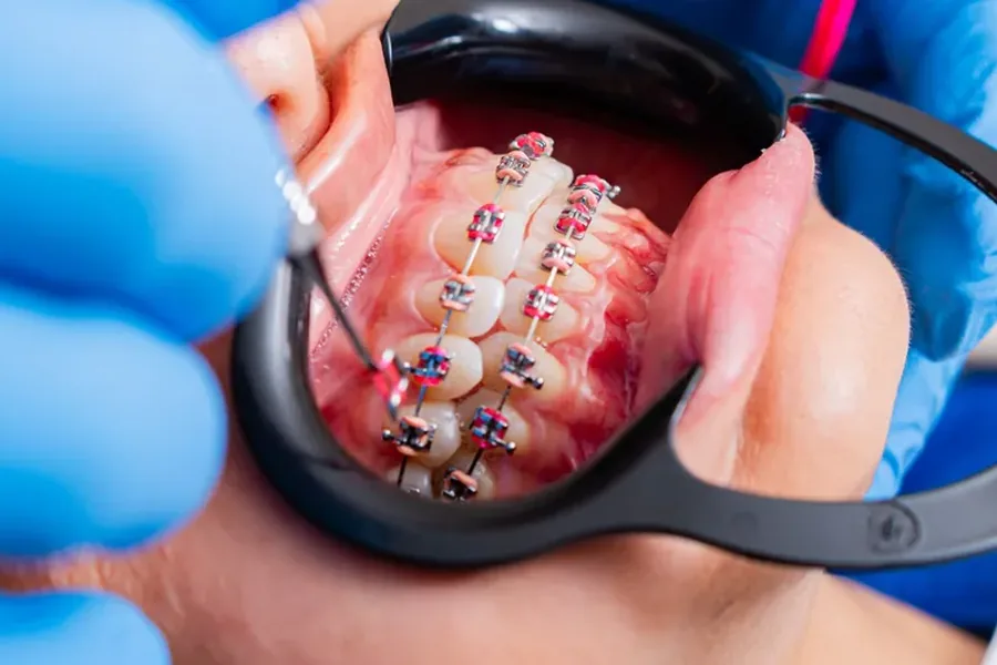 Orthodontic braces being checked during an adjustment appointment