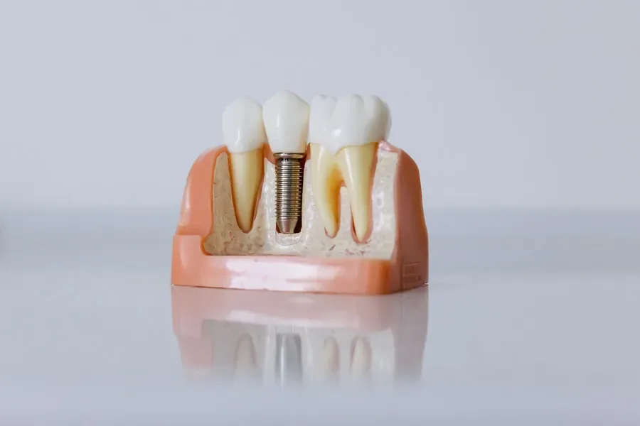 Dental implant model showing how a titanium post replaces a missing tooth root