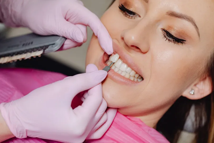 Porcelain veneer being fitted to a front tooth during a smile makeover